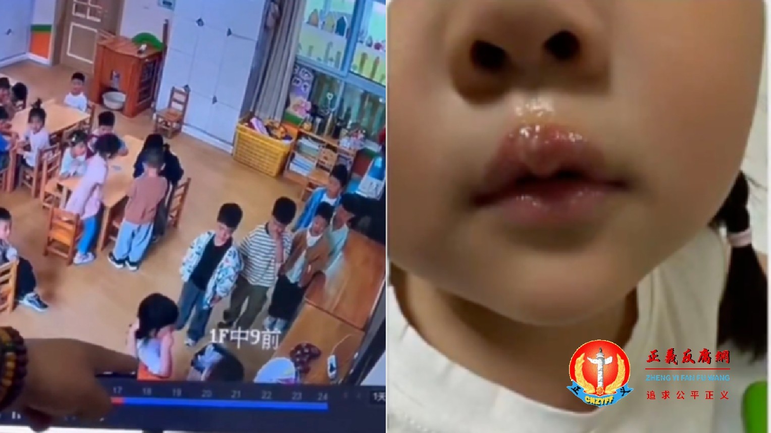微视频｜江苏徐州丰县机关第二幼儿园老师虐童，用热熔胶枪烫孩子嘴唇